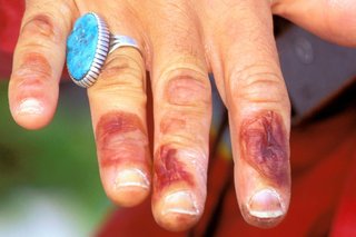 A person’s right hand with dark red blisters on their fingers caused by frostbite.