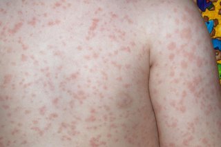 A blotchy, pink rash all over the chest and upper arm of a child with white skin.
