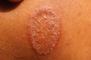An oval-shaped patch of scaly, reddish-brown skin on a child’s cheek, caused by ringworm. Shown on medium brown skin.