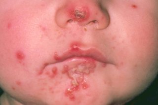 The lower half of a child's face with red and yellow weepy impetigo sores on their nose and around their mouth. Shown on white skin.