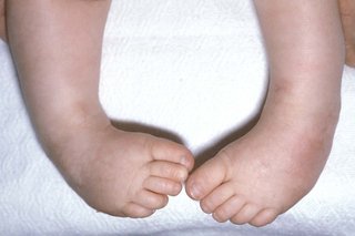 The feet of a baby with clubfoot. Both feet are bent at the ankle so the feet turn down and inwards.