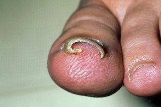 A person's big toe seen from the front. Their toenail has curved round into their toe.