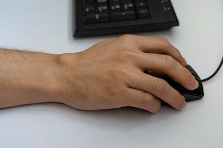 A ganglion cysts on the wrist of someone with white skin. There is a smooth skin-coloured lump, roughly 2cmin size on the top of the wrist.
