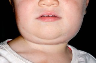 Lower half of the face of a child with white skin, pictured against a black background. The cheek and neck on the right-hand side is swollen from mumps, giving a "hamster-like" appearance.
